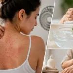 How to Get Rid of Heat Rash Quickly