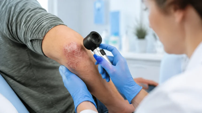Psoriasis Pictures Types, Symptoms and What to Know